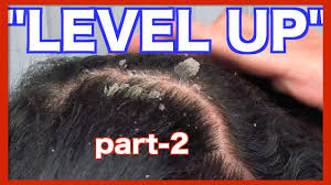 Send thanks to the doctor. These People Like Watching Videos Of Scratched Dandruff Dazed Beauty