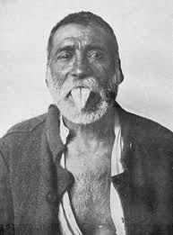 52 Pellagra Images: PICRYL