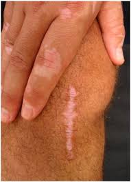 Image result for koebner phenomenon psoriasis