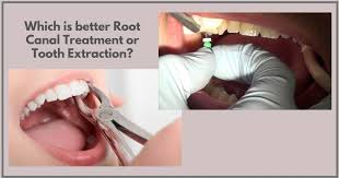After your tooth has been extracted, you'll be told to bite on a piece of gauze for up to 45 minutes to a root canal is often the preferred choice of treatment when compared to tooth extraction because it saves your natural tooth. Which Is Better Root Canal Treatment Or Extraction Expert Dental Care