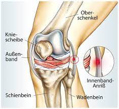 Typisch ist das läuferknie, das. Knieschmerz Innen Am Kniegelenk Medialer Knieschmerz Gelenk Klinik De
