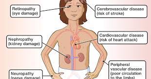 The mechanism behind the relation between diabetes and atherosclerosis is not fully understood. Complications Of Diabetes