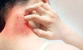 Fungal Infection Ko Jad Se Kaise Khatam Kare: These home remedies are a  panacea for fungal infection | Fungal Infection Ko Jad Se Kaise Khatam  Kare: फंगल इंफेक्शन के लिए रामबाण हैं
