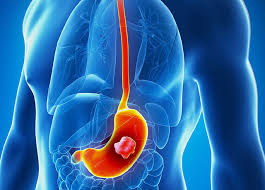 Stomach cancer, also known as gastric cancer, is a cancer that develops from the lining of the stomach. Stomach Cancer Causes Symptoms And Treatments