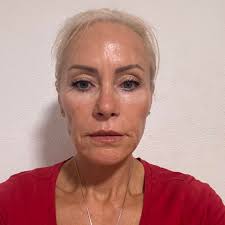 Has anyone had a SMAS neck lift? Here is my before, top left, and now three  weeks out. It's going right back where it was. Doc says skin will tighten  over the