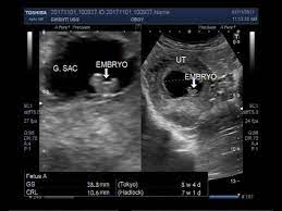 We did not find results for: Ultrasound Video Showing A Case Of Missed Miscarriage Of About 7 To 8 Weeks Youtube
