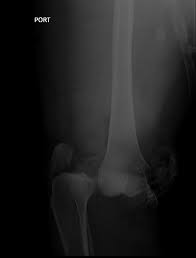 Image result for Knee XRay