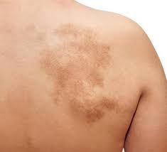 Birthmark Removal in Delhi, Laser Birthmark Removal in Dwarka, Delhi