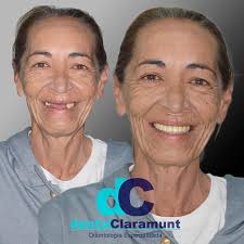 Antes y después de un tratamiento de rehabilitación oral mediante implantes  dentales, realizado por el Dr.Victor Cabrera Claramunt y la Dra.Nadine Mata  ✨ . . #dentalclaramunt #implantesdentales #implantologia #implantology  #implant #implantes #prótesis #
