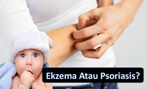 Home » bayi » sakit » 8 penyakit kulit pada bayi paling umum. Cara Merawat Ekzema Dan Psoriasis Penyakit Kulit Pada Bayi Laman Media