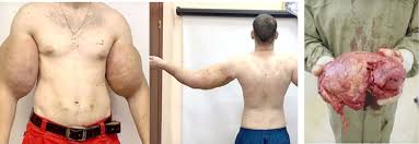 But he also revealed he'd been injecting something kind of weird: Man Has 3lbs Of Rotting Muscle Removed After Injecting Himself With Oil Dailytrust