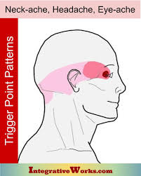 Pin On Headaches Cervicogenic