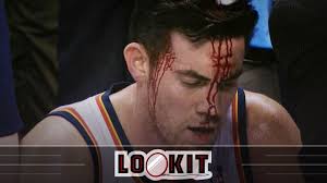 Nick Collison got staples in his head after this (#LOOKIT)