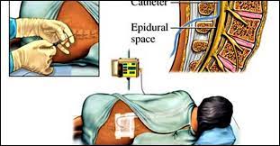 Epidural Analgesia For Labor Why Is It Done And What Are Its Effects