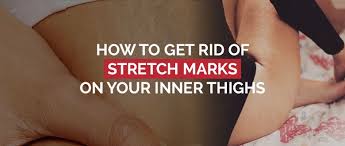 The juice squeezed from lemons is naturally acidic and therefore plays an important role in healing the skin, and eliminating acne, scars, and stretch marks. 4 Ways To Get Rid Of Stretch Marks On Your Inner Thigh Fast
