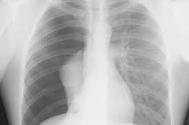 Image result for Open Pneumothorax