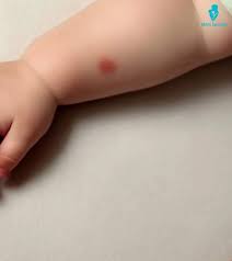 Image result for mosquito bite
