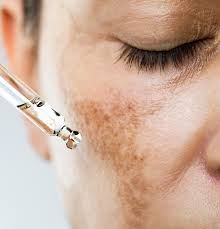 Image result for Melasma