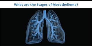 Advancements in treating cancer occur almost every day. The 4 Mesothelioma Stages Explained