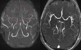 Hasbullah magomedov is on facebook. Moyamoya Wikipedia