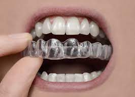 Retainers are crucial to helping you along your leveling path. Hawley Retainers Archives Sportingsmiles