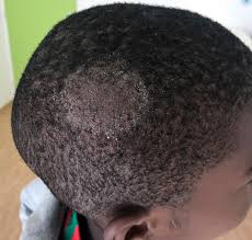 Candida albicans, is an opportunistic yeast that normally inhabits the mouth, throat, intestines and genitourinary tract of most humans and is usually. Tinea Capitis Wikipedia