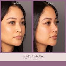 Rhinoplasty