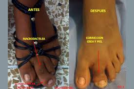 Decoración de uñas de los pies sencillas. Dedos Deformes Centro Integral Del Pie Traumatologo En Guayaquil