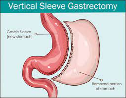 Scars and loose skin after vsg are pretty typical and common. How Long Does It Take To Recover From Gastric Sleeve Surgery The London Obesity Group
