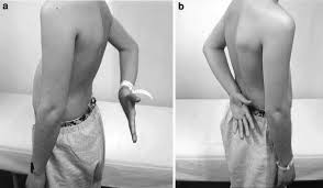Image result for Lift-Off Subscapularis Test