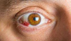 Le stress est l'une des causes les plus courantes provoquant l'apparition sang dans l'oeil. Du Sang Dans L Oeil Faut Il S Inquieter Passionsante Be