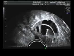 The entire process is virtually painless and takes seconds to complete. Ivf Egg Retrieval In Vitro Egg Aspiration Process Video