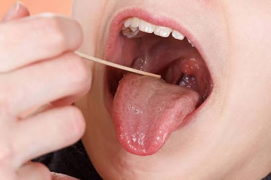 Cách chữa Bệnh ứ đờm trong cổ họng