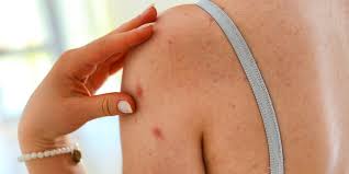 Macchie della pelle, le immagini per riconoscerle. Porri Della Pelle Cosa Sono E Rimedi Roba Da Donne