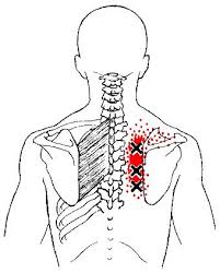 Pin By Carrie Mills On Massage Therapy Trigger Points Muscle Knots Dry Needling