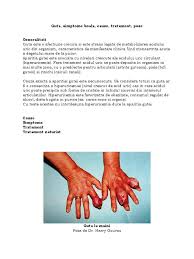 Uric acid is a product of the metabolic breakdown of purine nucleotides. Guta