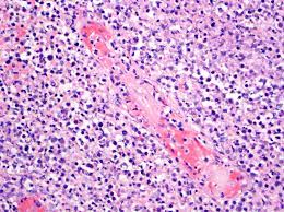 Blood, the journal of the american society of hematology. Pathology Outlines Extranodal Nk T Cell Lymphoma Nasal Type