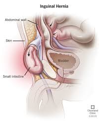 Check spelling or type a new query. Inguinal Hernia Types Symptoms Diagnosis Treatments