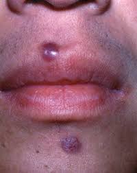 Kaposi's sarcoma (ks) is a type of cancer that can form masses in the skin, in lymph nodes, in the mouth, or in other organs. Kaposi S Sarcoma Guide Causes Symptoms And Treatment Options