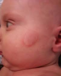How Does Ringworm Look While It Is Healing Ringworm Pictures Ringworm On Face Skin Infections Pictures