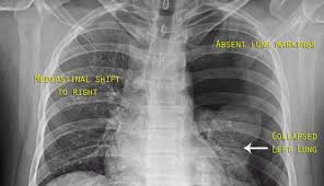 Image result for Open Pneumothorax