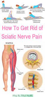 Sciatica