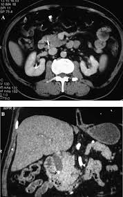 Ct scans are far more expensive, they expose patients to a low dose of radiation, and the centers for disease control and prevention and some medical groups recommend against using them to. A Ct Scan Showing Metallic Artifact In The Distal Common Bile Duct Download Scientific Diagram