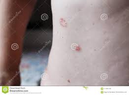 Non è nota la causa scatenante delle malattie autoimmuni. Pelle Di Psoriasi La Psoriasi E Una Malattia Autoimmune Che Colpisce L Infiammazione Della Pelle Di Causa Della Pelle Rossa E Squ Fotografia Stock Immagine Di Cronico Dermatologia 111841726