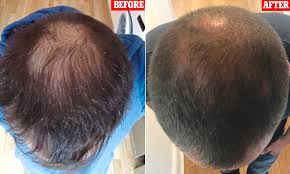 Alopecia is a generic term used for any hair loss from part of the head or body where. Pioneering Stem Cell Procedure That Doesn T Just Prevent Hair Loss But Reverses It Daily Mail Online