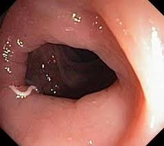 Image result for Pinworm