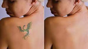 How to lighten a tattoo naturally without pain. What Happens To Tattoos When You Remove Them Big Think