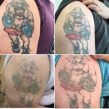 Clearit is an emerging technology company which is developing and will soon be marketing a new, effective, painless, single treatment tattoo removal device. Pin On Before After Photos Picosure Laser Tattoo Removal