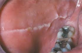 Biting The Inside Of Your Cheek By Accident Pin On Orchards Dental Care Facts And Tips