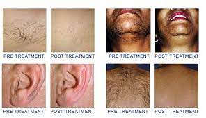 The empyreus hair remover gently pulses light flashes on the skin which are absorbed by the hair roots. Safe Laser Hair Removal For Men Women And Teens Of All Skin Colors Laser Hair Removal Miami Laser Hair Removal Hair Removal For Men All Skin Colors